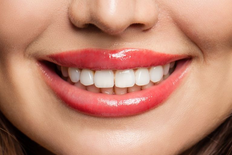 Lip Flip Gummy Smile Botox in Itzehoe.